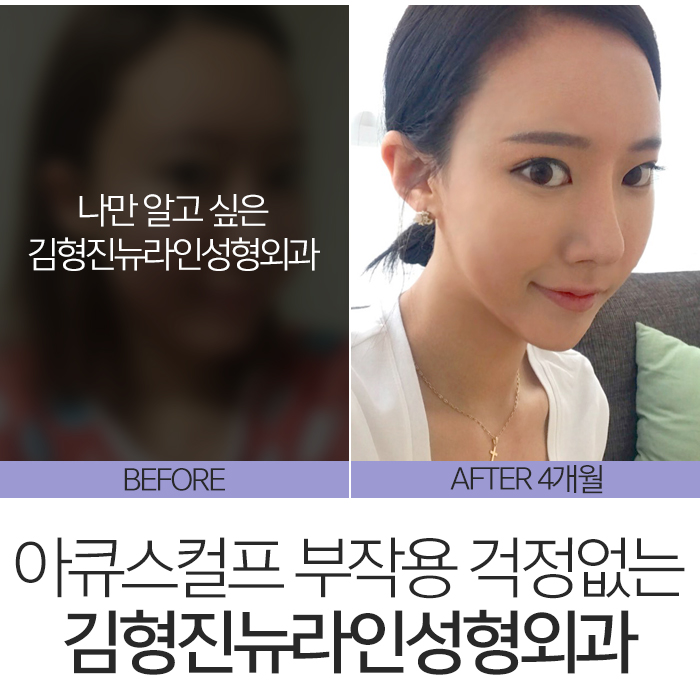 아큐스컬프부작용 걱정된다면 관련 이미지 8