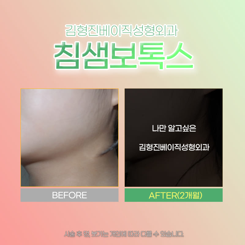 강남침샘보톡스로 부드러운 턱 선 만들고 싶다면 관련 이미지 5