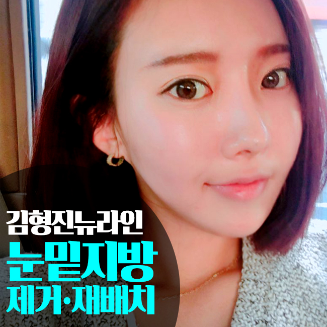 눈밑지방제거가격보다 중요한건 ? 관련 이미지 1