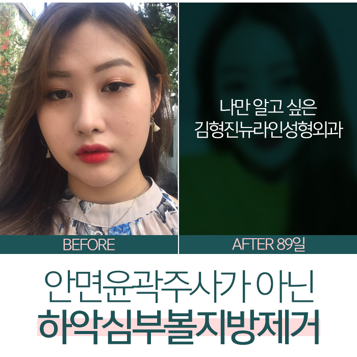 안면윤곽주사전후 보다 확실한걸 찾는다면 관련 이미지 2