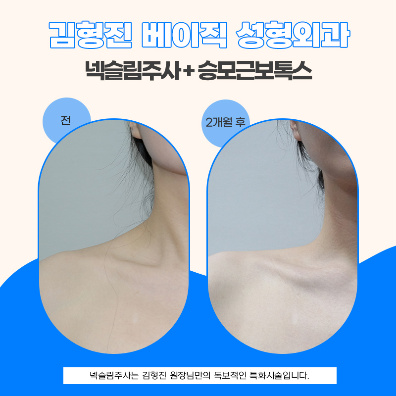 목보톡스로 두꺼운 목 라인을 슬림하게 가꾸는 방법 관련 이미지 5