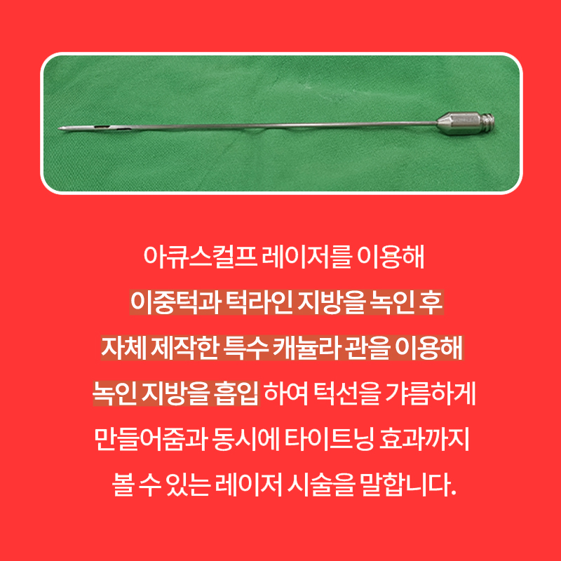 압구정얼굴지방흡입 덕분에 보름달 얼굴 극복했습니다! 관련 이미지 5