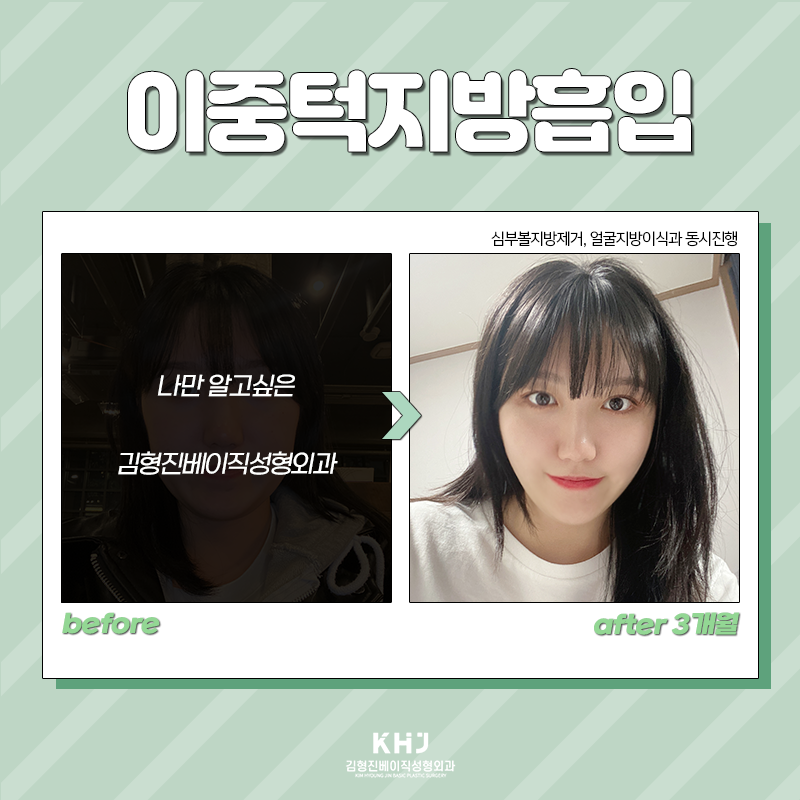 이중턱지방흡입전후 확인하고 가세요! 관련 이미지 6