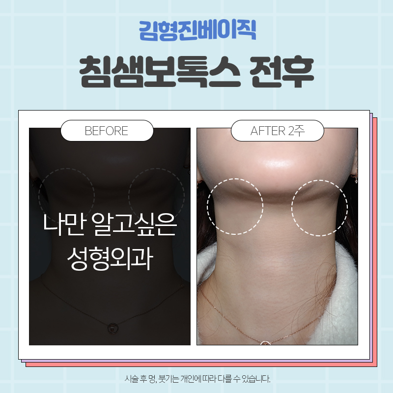 침샘보톡스전후 확실한곳, 김형진베이직 관련 이미지 3