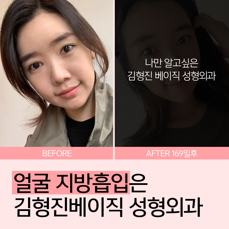 아큐스컬프로 얼굴살 깔끔하게 해결 관련 이미지 3