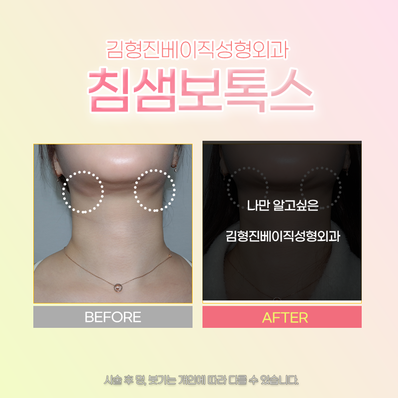 침샘치료 더 이상 미루지 마세요! 관련 이미지 3