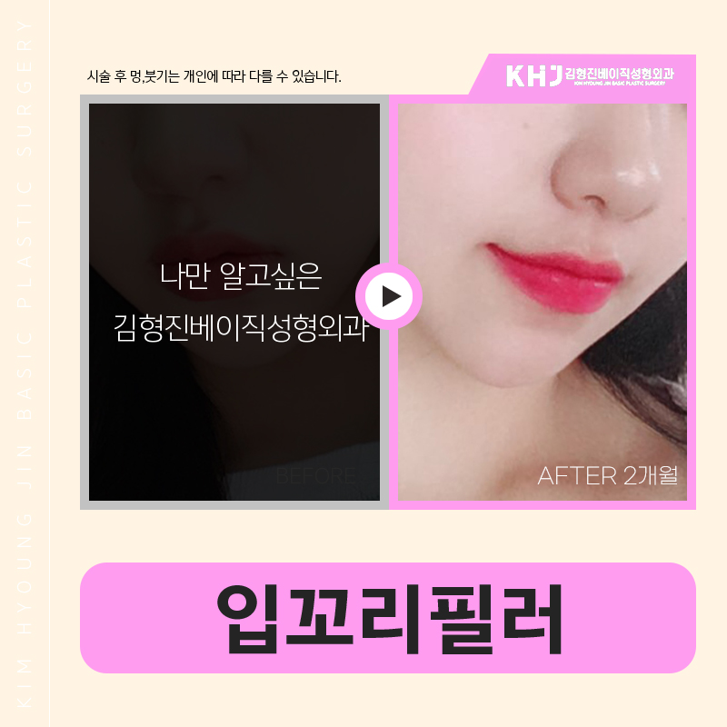 입꼬리필러로 부드럽게 입꼬리올리는방법 관련 이미지 6