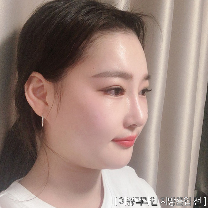 턱지방분해주사 효과 못 보지 않았어요? 관련 이미지 1