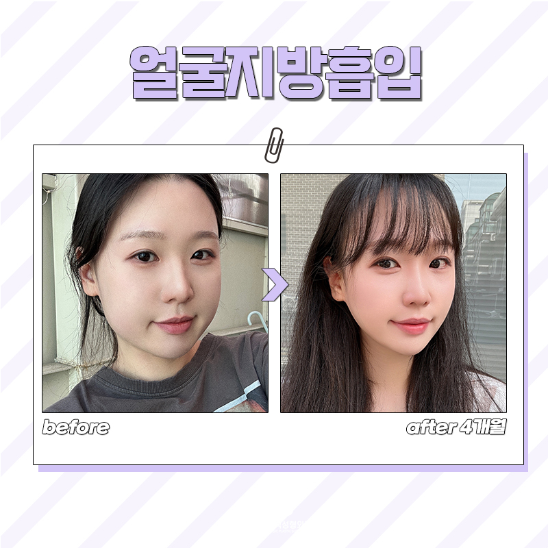 얼굴지방없애는방법 이거 한번이면 끝입니다! 관련 이미지 6