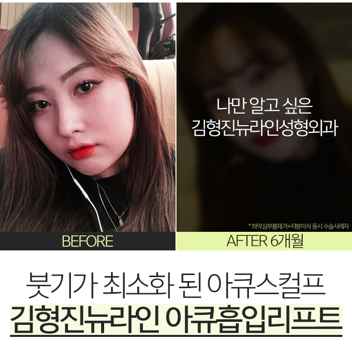 얼굴아큐스컬프 안 할 이유가 없죠 관련 이미지 6