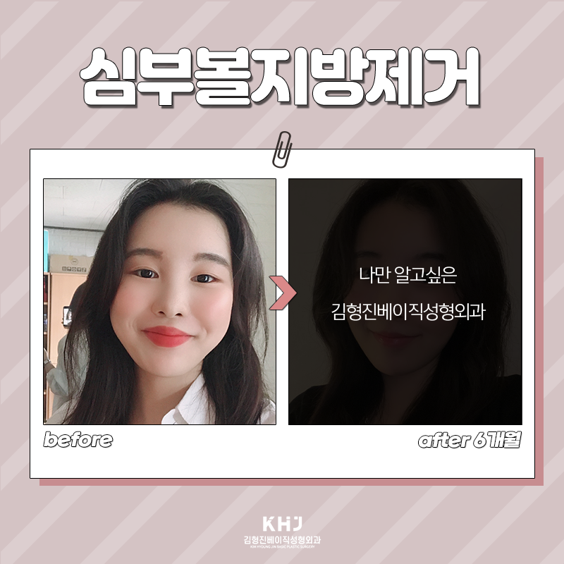 심부볼제거전후 보고 가실래요~? 관련 이미지 5