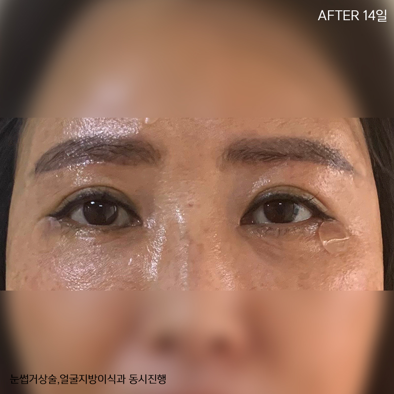 미니하안검회복과정 한 눈에 확인! 관련 이미지 5