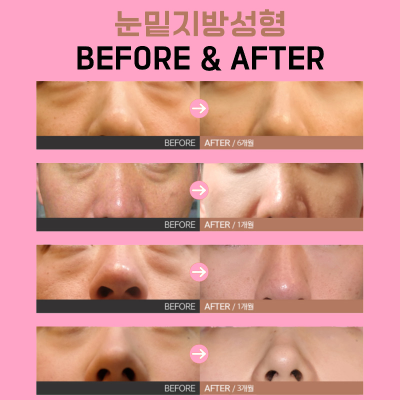 눈밑지방재배치부기 얼마나 가는지 궁금하다면? 관련 이미지 6