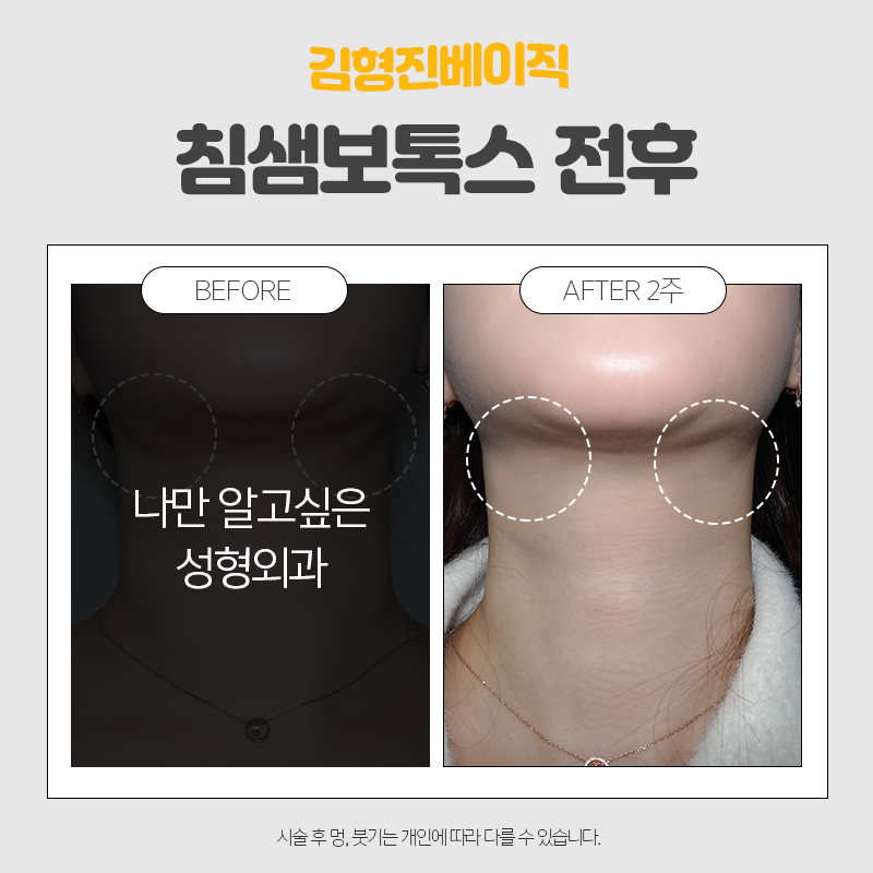 침샘치료를 해야한다면 관련 이미지 3