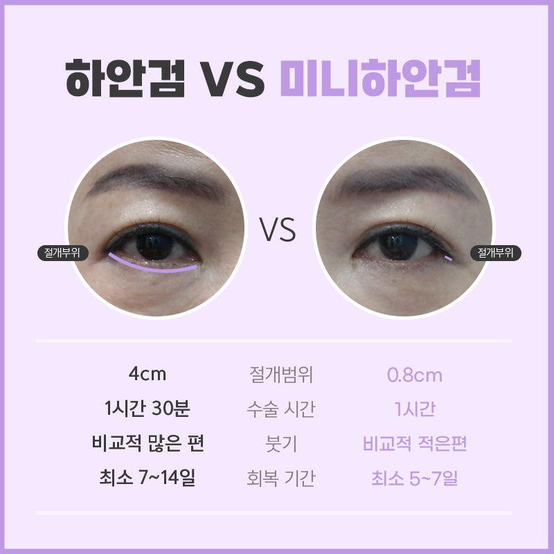 중년하안검 아무거나 하지 마세요 관련 이미지 4