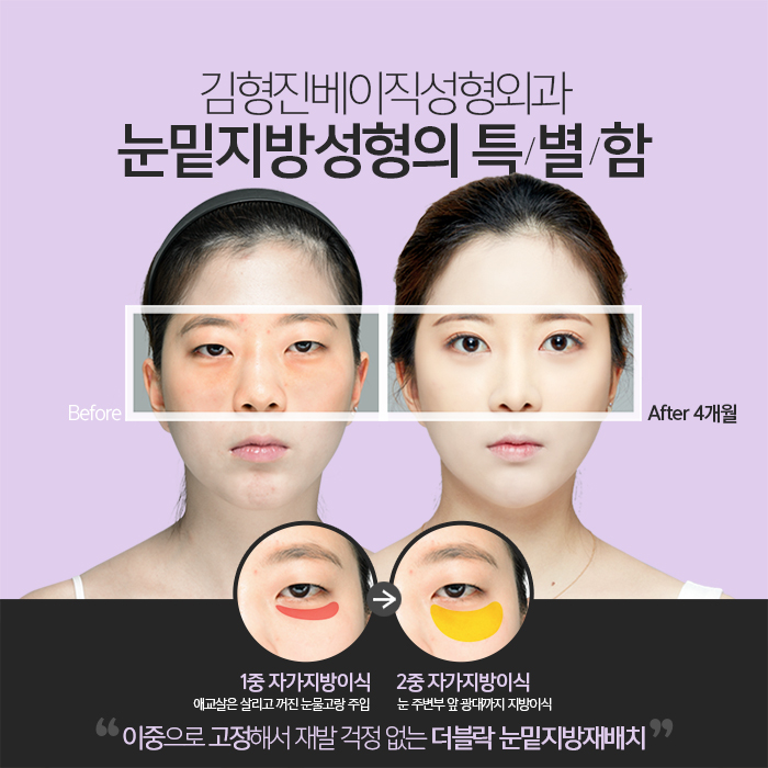 연예인눈밑지방재배치 이런 거구나 관련 이미지 4