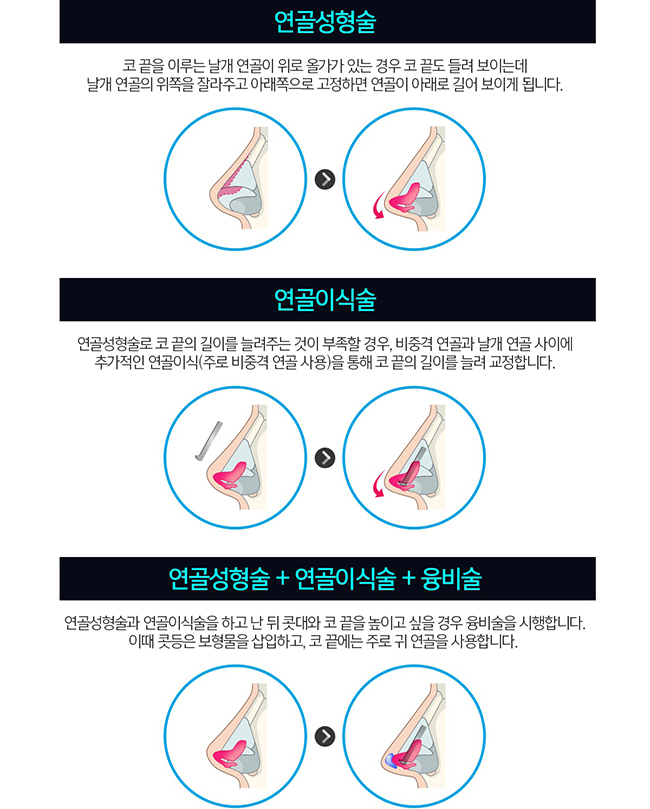 코성형종류 나에게 알맞은 것은~? 관련 이미지 3