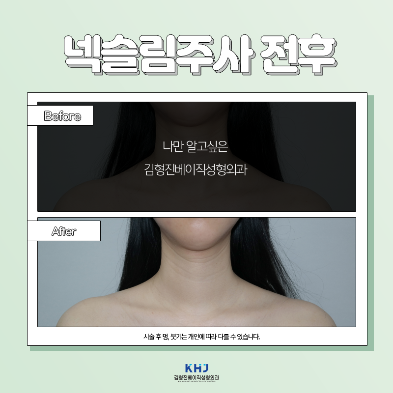 두꺼운목 해결방법 알려드립니다~! 관련 이미지 3