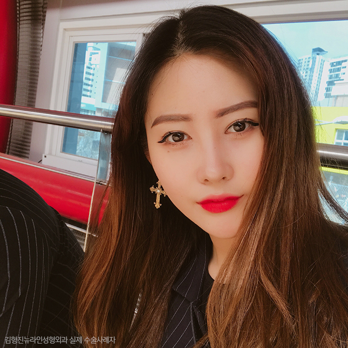 얼굴아큐스컬프 안 할 이유가 없죠 관련 이미지 1