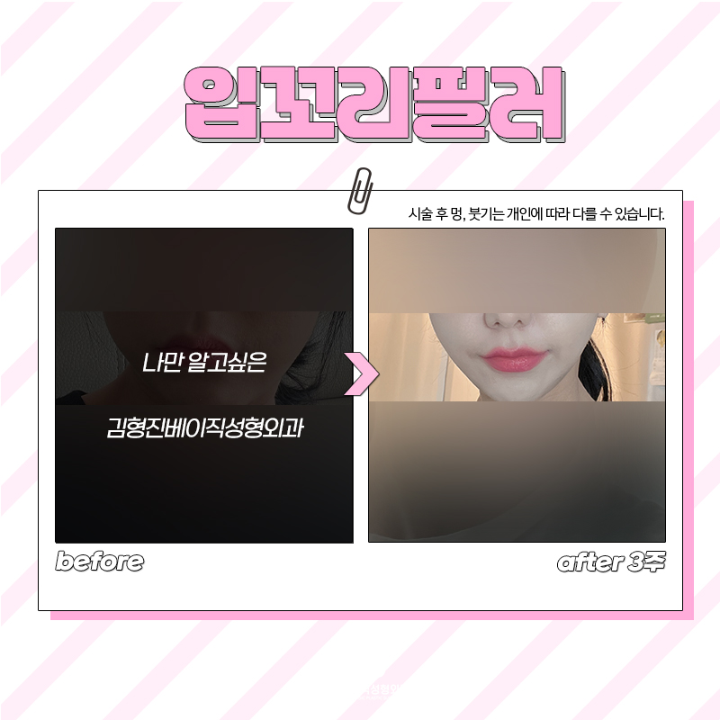 입꼬리교정을 통해 웃는 인상 완성해요 관련 이미지 6