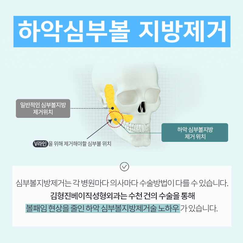 울퉁불퉁 얼굴형, 심부볼지방제거수술 받으면 어떻게 될까? 관련 이미지 4