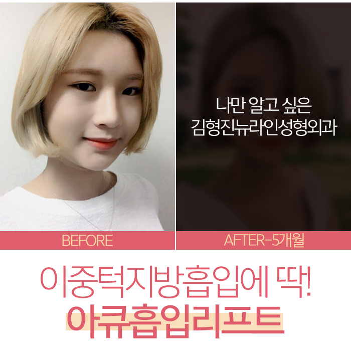 턱살지흡 진짜일까? 관련 이미지 3