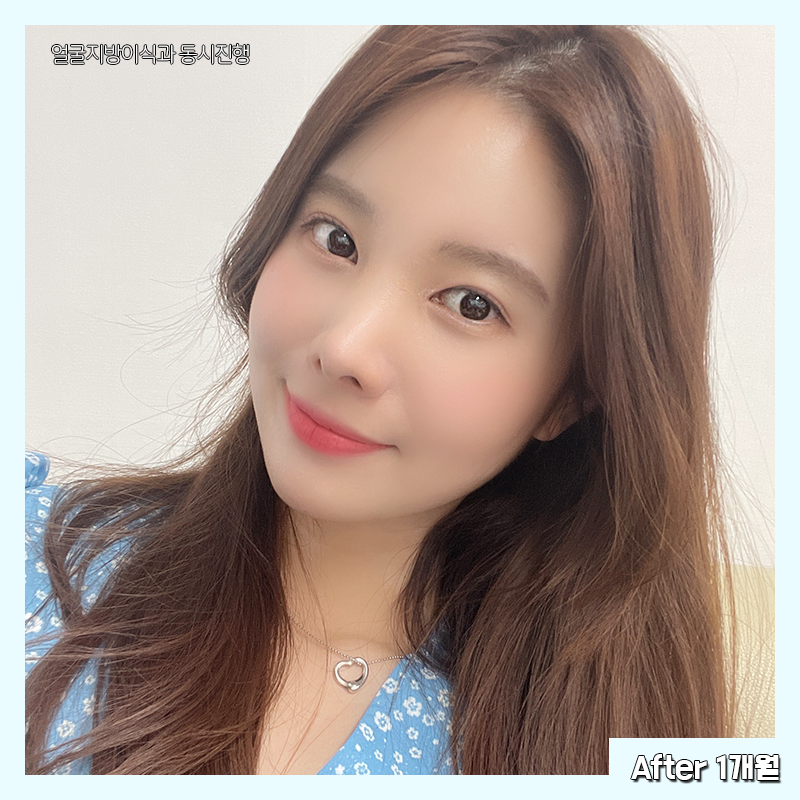 얼굴지흡효과 얼마나 좋냐면요 관련 이미지 6