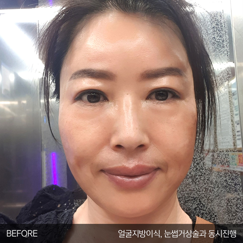 미니하안검수술은 김형진베이직이죠 관련 이미지 2