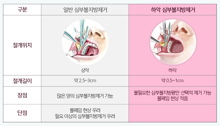 심부볼지방제거성형외과 김형진뉴라인, 알죠? 관련 이미지 5