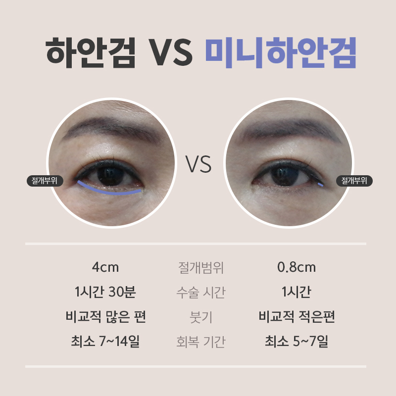 중년눈밑성형 전에 무조건 이걸 알고 가셔야 합니다! 관련 이미지 3