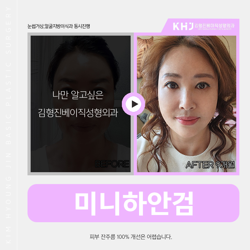 중년눈성형 고려 중이라면 김형진베이직에서! 관련 이미지 5
