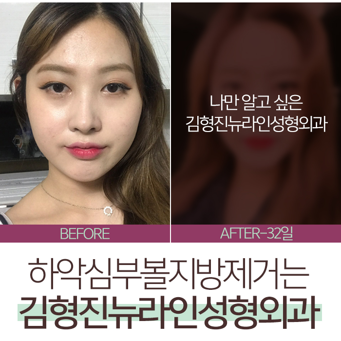 심술보제거 어떻게 하냐구? 관련 이미지 3