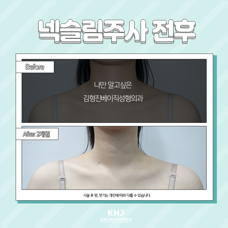 넥슬림주사효과 아직도 모르신다구요? 관련 이미지 5