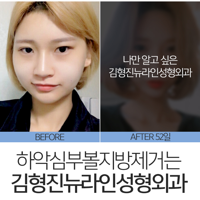 하악심부볼지방제거 보면 놀라요 관련 이미지 8