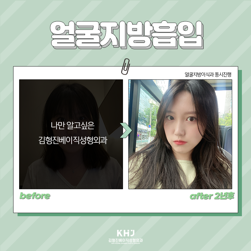 얼굴지방흡입붓기 걱정되신다구요? 관련 이미지 6