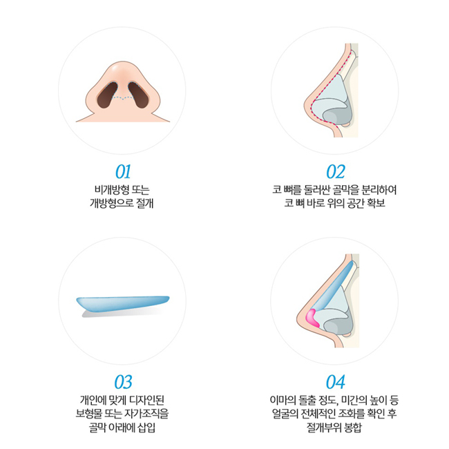 낮은코성형으로 높은코되기! 관련 이미지 2
