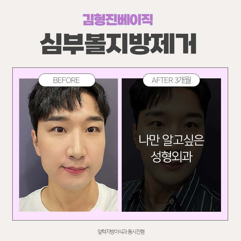 Cheek Fat Removal Review — I Didn’t Expect Such a Big Difference... image 5