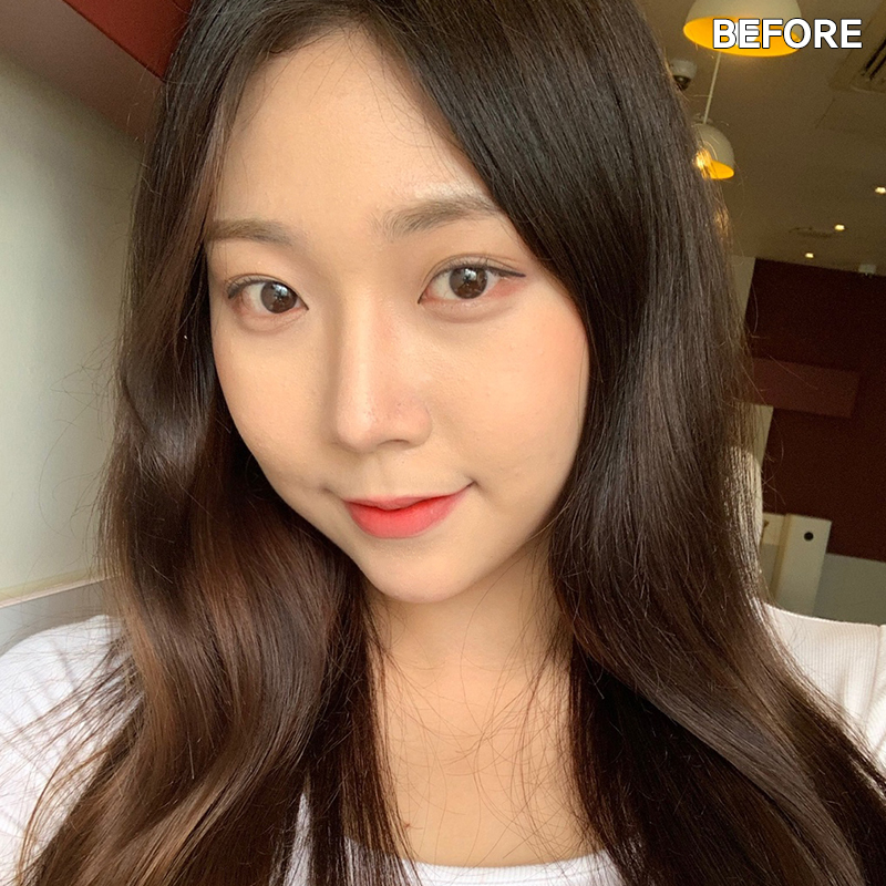 심부볼제거수술을 왜 받냐구요? 관련 이미지 2