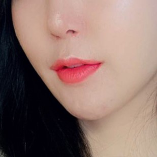 후기 많은 입꼬리필러추천이 필요하다면 여기에요! 관련 이미지 3