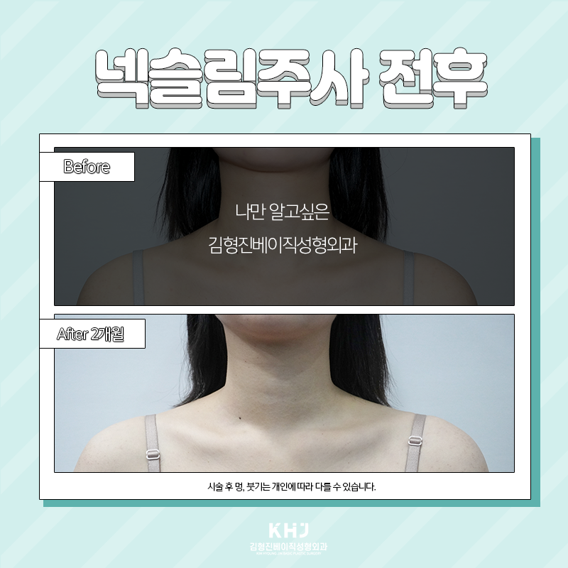 넥슬림주사효과 언제부터 볼 수 있냐면요 관련 이미지 3