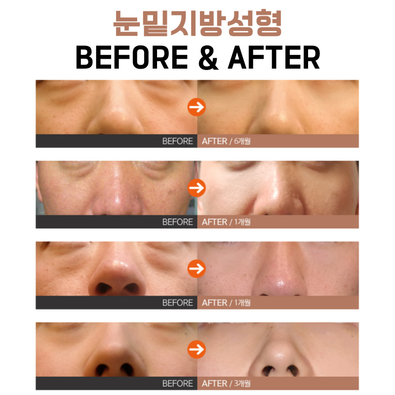 강남눈밑지방재배치로 눈가를 매끈하고 생기있게! 관련 이미지 5