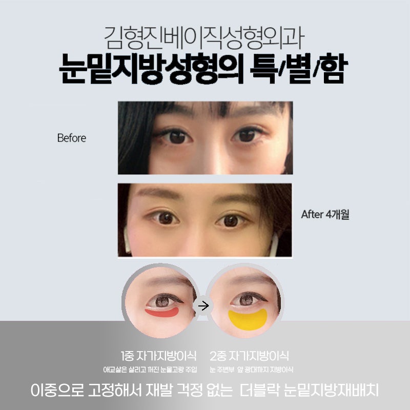 울룩불룩한 눈 밑, 눈밑지방재배치수술로 해결했어요 관련 이미지 4
