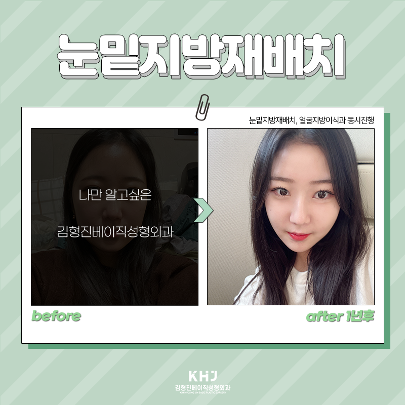 압구정눈밑지방재배치 찾고 계셨다면? 관련 이미지 6