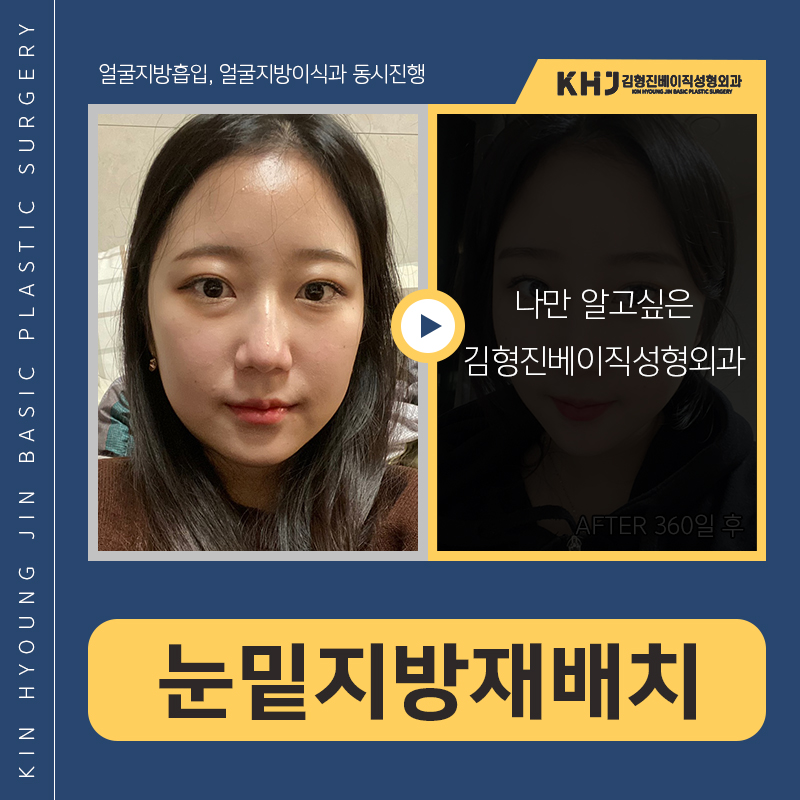 눈밑지방재배치재수술 걱정마세요 관련 이미지 3