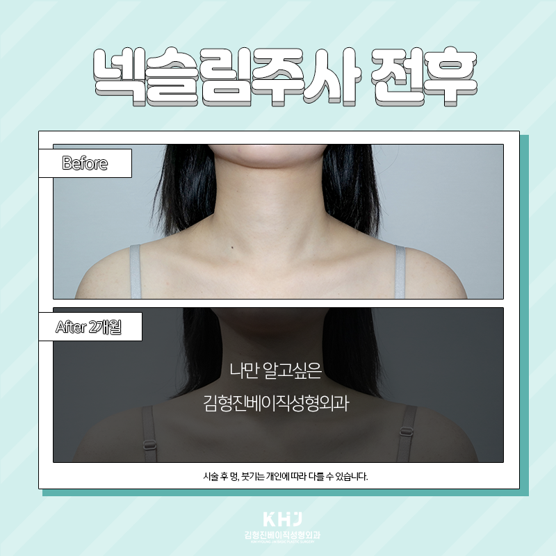 넥슬림주사효과 언제부터 볼 수 있냐면요 관련 이미지 2