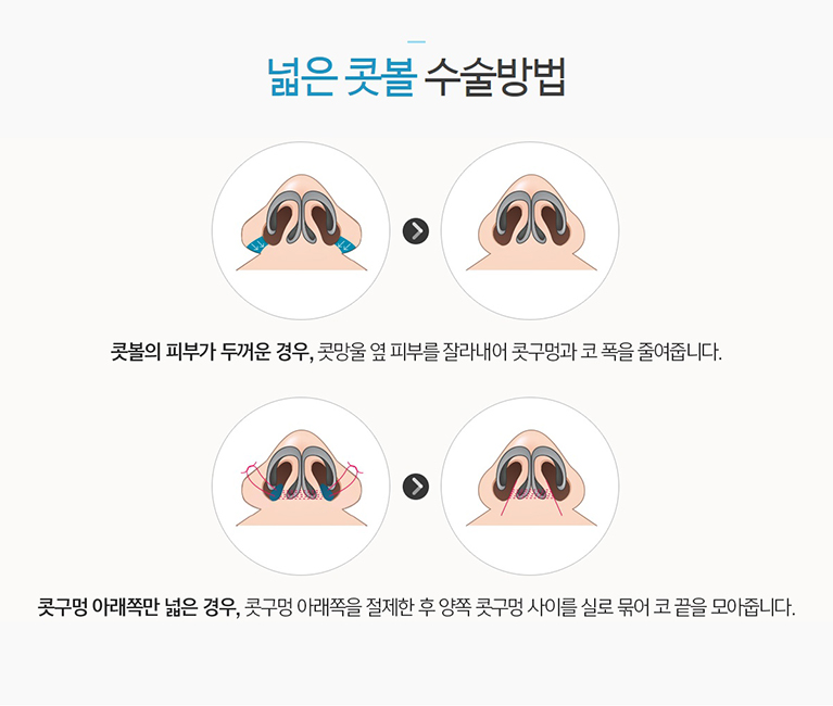 코성형종류 나에게 알맞은 것은~? 관련 이미지 5