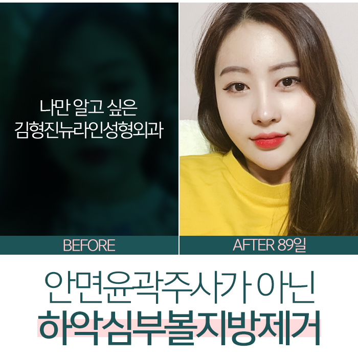 안면윤곽주사전후 보다 확실한걸 찾는다면 관련 이미지 6
