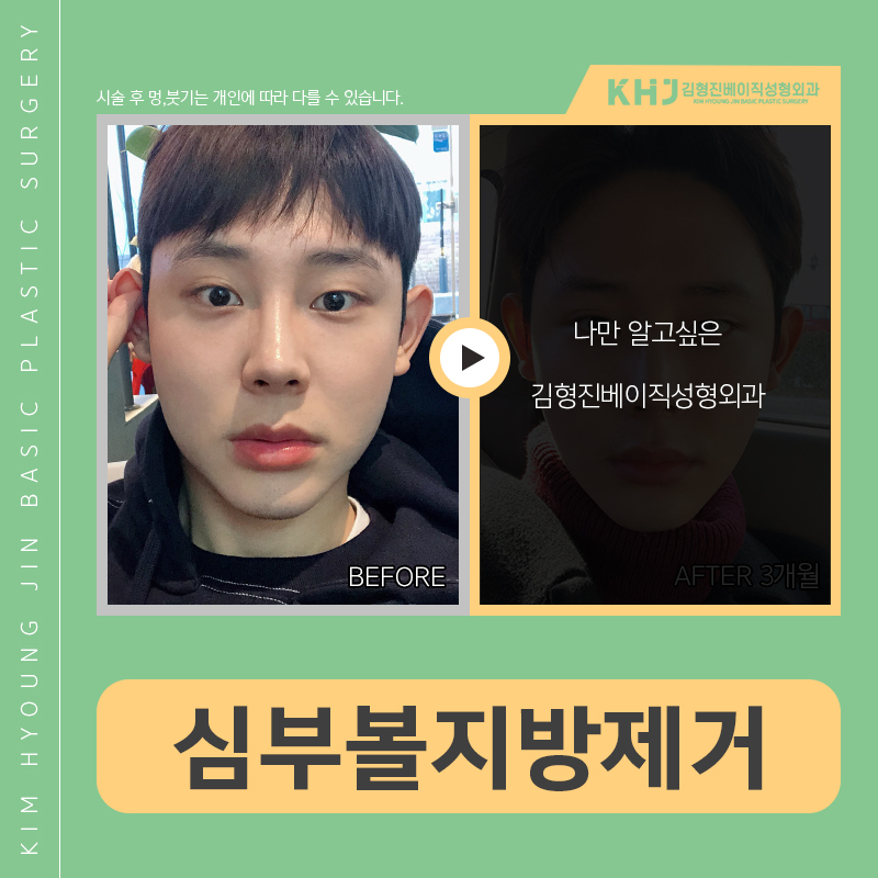 인모드 심부볼, 해결 안 되는 이유는 이거! 관련 이미지 3