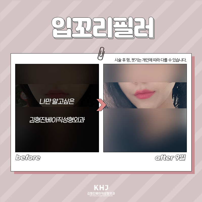 입꼬리필러모양 과하지 않게 원하신다면? 관련 이미지 4