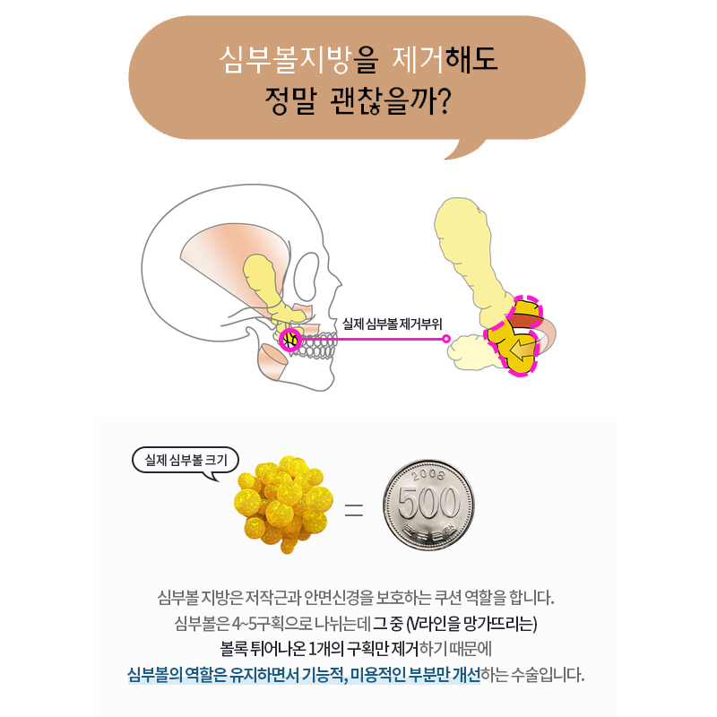 볼살제거 하고 V라인 장착하고 왔어요! 관련 이미지 4